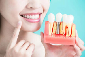 Does Medicare Cover Dental Implants?